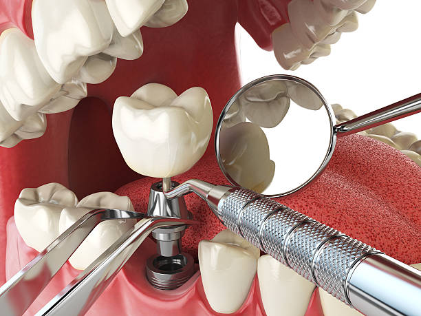 Best Emergency Dental Surgery in Veedersburg, IN